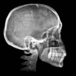 Human Skull X Ray Image Isolated On Black